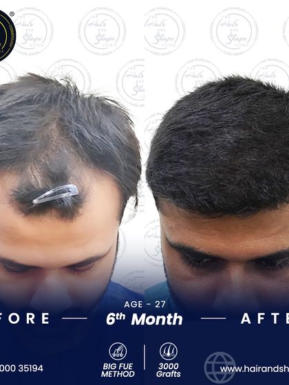 This patient's 6-month progress after a 3000-graft BIG FUE transplant. The density and coverage are already looking excellent.