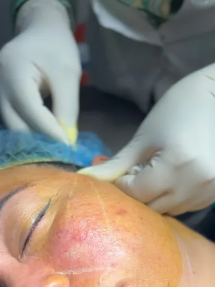A close-up of a threadlift procedure in progress. The threads are carefully inserted beneath the skin to create a supportive mesh that lifts sagging tissue and stimulates collagen production.