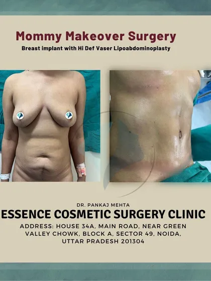 A static before and after image of the Mommy Makeover shown in the previous video. This highlights the combination of breast enhancement and abdominal sculpting to achieve a complete post-pregnancy transformation.