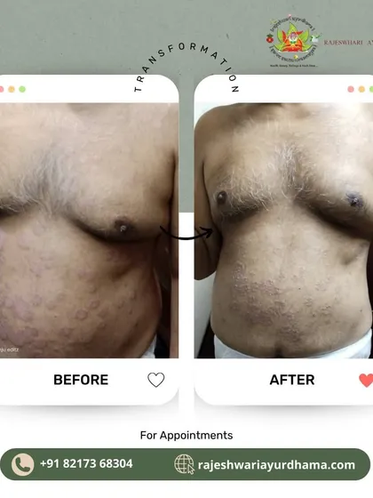This is another example of how my treatments can manage persistent skin conditions. This client saw a visible reduction in skin plaques and irritation on their torso after following a personalized Ayurvedic regimen.