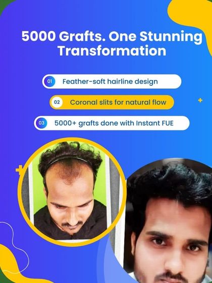 5000 grafts lead to one stunning transformation. This before and after result was achieved using our feather soft hairline design and Instant FUE technique for a completely natural flow.