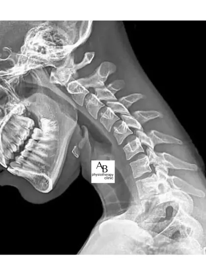 This is a real X-ray showing the effects of "Tech Neck." The constant forward head posture straightens the natural curve of the cervical spine, leading to chronic pain and degeneration.