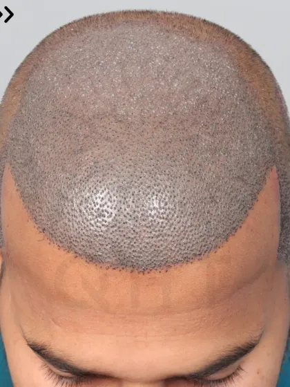 A Diffuse Grade 5A transformation begins with 5850 grafts. We recreated the hairline, frontal part, mid-scalp, and temples.
