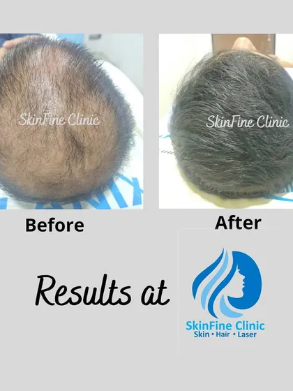 This before and after image shows the result of a 5-month treatment plan for a patient with a 3-year history of hair loss. After a thorough trichoscopic assessment and blood tests, we used a combination of micro-PRP therapy and cyclical supplements to achieve this significant hair regrowth.