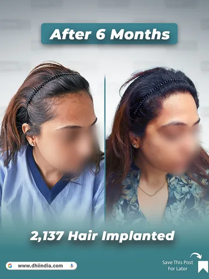 We specialize in female hair restoration, as shown in this 6 month before and after. Using our no-shave hair transplant technique, we implanted 2,137 hairs to restore her hairline and add density, achieving a beautiful and natural result without compromising her existing hair.