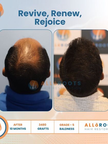 Revive, Renew, Rejoice. This 10-month result for a Grade 5 baldness case, using 3480 grafts, shows a complete restoration. The images from all angles prove that a full head of hair is an achievable goal.