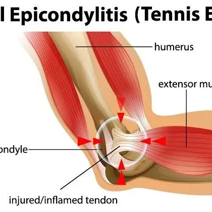 An anatomical diagram explaining Tennis Elbow (Lateral Epicondylitis). Understanding the injury is the first step to treating it.