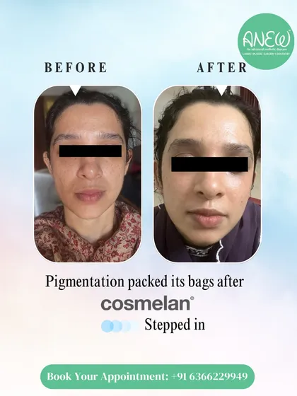 This is the power of a targeted, professional treatment plan. Our Cosmelan peel is a world-leading depigmentation method that effectively reduces stubborn melasma and hyperpigmentation, revealing a dramatically clearer and more even-toned complexion.