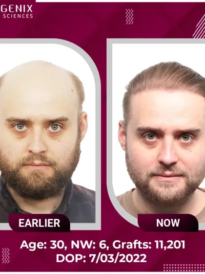 This is the power of doing it right, the first time. We transformed this patient's Grade 6 baldness with 11,201 grafts, restoring not just a full head of hair, but a youthful look that is completely natural. This is the standard of artistry we bring to every procedure.