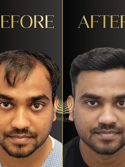 A great before and after transformation. The patient's new hair looks natural, dense, and has completely revitalized his appearance.