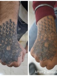 Body Piercing & Tattoo Removal