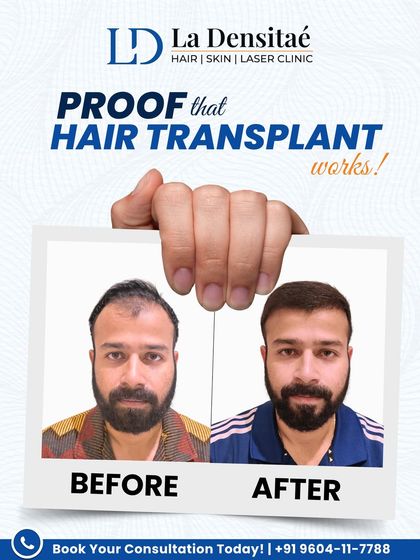 For years, Vikas was unsure if a hair transplant could really make a difference. With 2,500 grafts using the RT-FUE technique, I rebuilt his hairline naturally, with no scars, just real results. This is proof that hair restoration works.