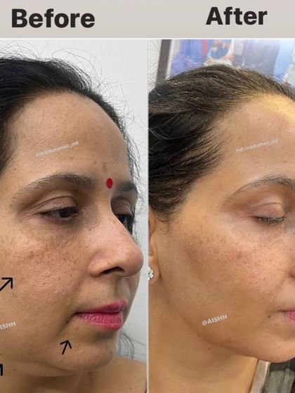 This is a non-surgical facelift result. By strategically placing fillers, I was able to lift sagging skin in the mid and lower face, reduce fine lines, and restore a more youthful and revitalized appearance.
