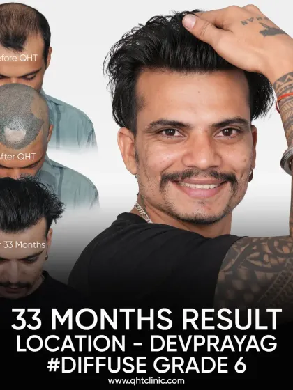 A 33-month result for a Diffuse Grade 6 patient. With 4700 grafts, his result is sustained and natural even after almost 3 years.