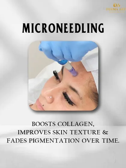 Microneedling is a powerful tool against pigmentation. It boosts collagen, improves skin texture, and helps fade discoloration over time.