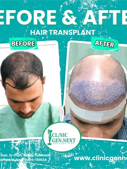 A clear before-and-after of the transplant process. You can see the pre-op hair loss and the scalp right after the grafts have been implanted.