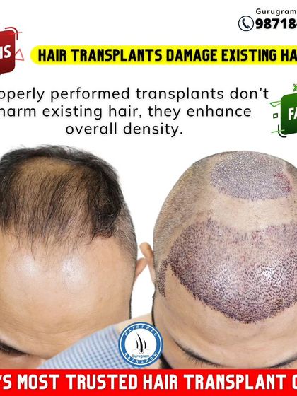 **Myth:** Hair transplants damage existing hair. **Fact:** When performed correctly by an experienced surgeon, the procedure does not harm existing hair. In fact, it is designed to enhance the overall density by adding hair to thinning areas.