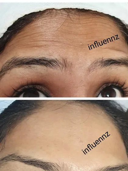 An incredible result from a Botox treatment. This before and after shows a complete smoothing of forehead lines for a flawless, youthful look.