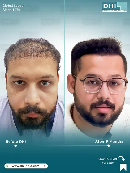 A frontal before and after of the same 25-year-old correction case. Nine months after our DHI procedure, his hairline is restored, and his confidence is back. This is the DHI difference.