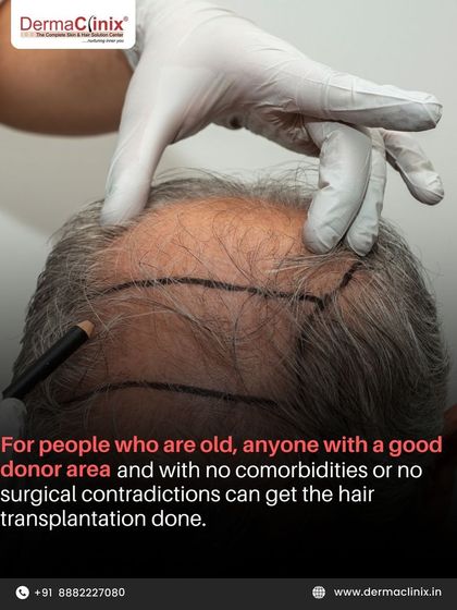 For older individuals, a hair transplant is possible with a good donor area and no major health issues. We have successfully performed transplants on patients well into their sixties.