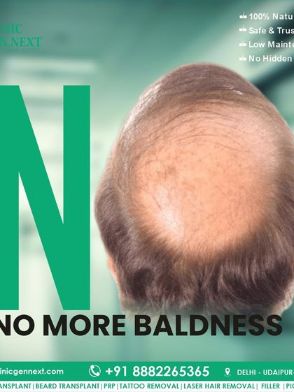 No more baldness. I offer safe, trusted, and low-maintenance hair transplants with no hidden charges for a 100% natural result.