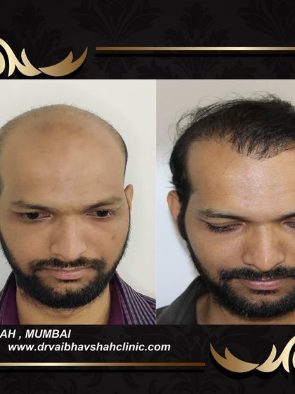 The top-down view of the same patient, confirming the excellent coverage achieved over the entire bald area.