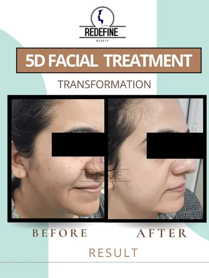 Another look at the transformative results of our 5D Facial. The client's skin is visibly lifted and smoother, with a noticeable reduction in the signs of aging.