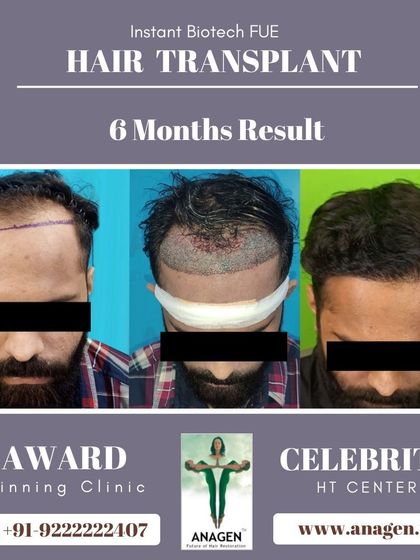 A 6 month result of an Instant Biotech FUE hair transplant, showing the progression from pre op to post op to the final impressive outcome.