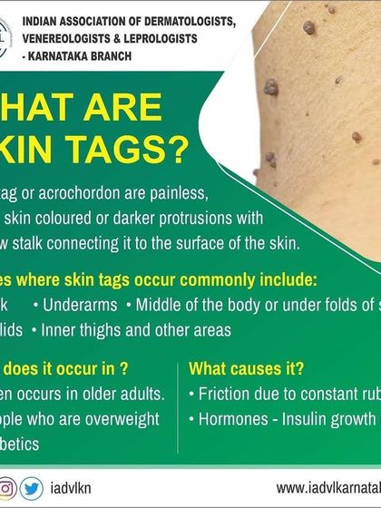 This educational graphic defines skin tags, or acrochordons, and lists common areas they appear. It also explains the typical causes and demographics, such as friction, hormones, and age.