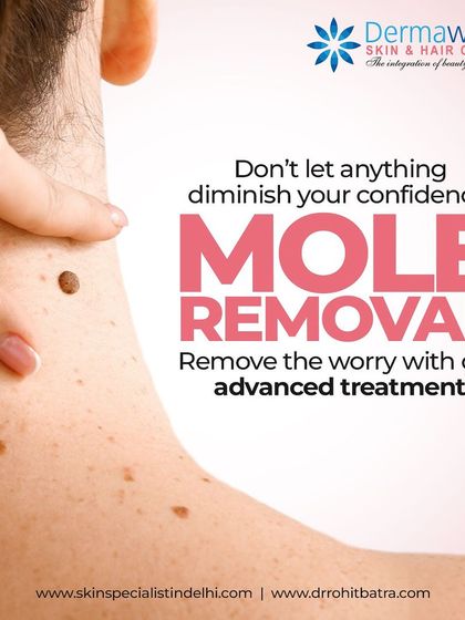 While most moles are harmless, you might consider removal for cosmetic reasons or if one causes discomfort. I provide advanced, safe mole removal treatments to help you feel more confident in your skin.