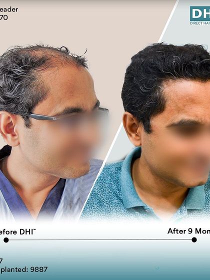 Another side-profile view of the 9-month transformation. This angle highlights the seamless integration of the new hair, creating a natural and aesthetically pleasing outcome.