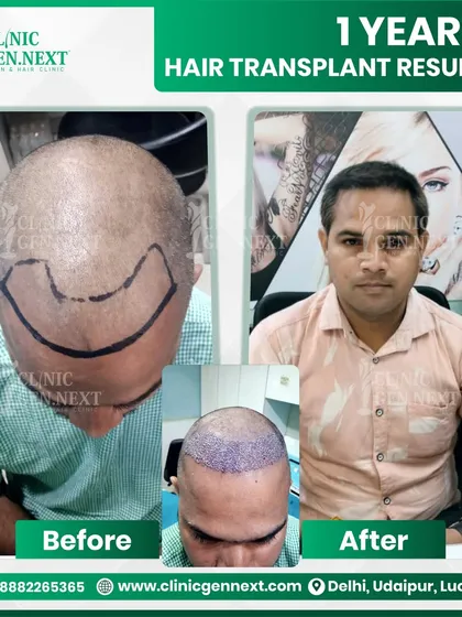 From a fully bald front to a confident new hairline in just one year. This image shows the pre-op marking, the immediate post-op placement, and the final, natural-looking result.