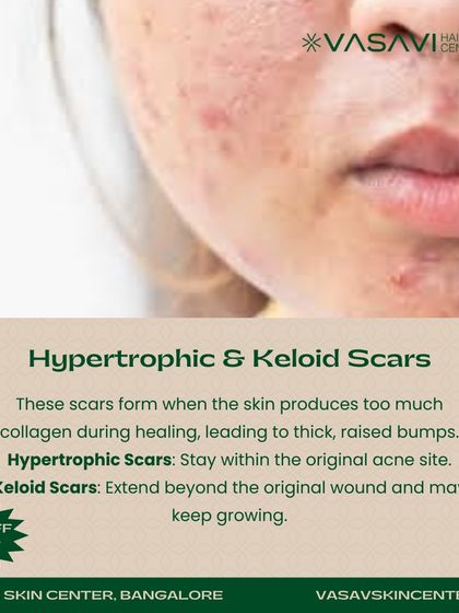 Sree Vasavi - Wart, Skin Tag & Keloid Removal Advanced Keloid and Scar Flattening photo 3