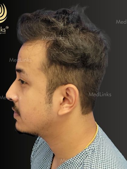 The patient's hair from the side before the procedure.