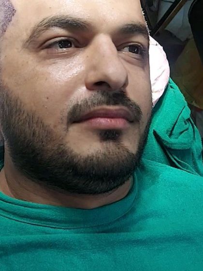 Another view of a patient during the FUE procedure, showing the newly transplanted area on the hairline.