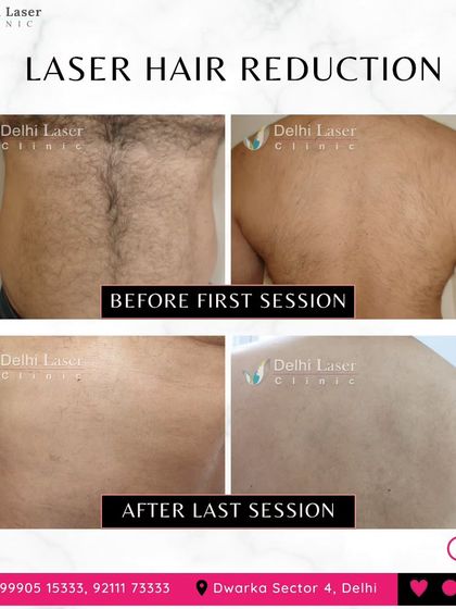 These before and after photos display the complete hair reduction on a male client's back and abdomen. The images clearly show the transition from dense hair growth to smooth, clear skin after the completion of his treatment package.