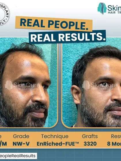 This 36-year-old patient with Norwood Grade V baldness received 3320 grafts. The 8-month result shows a dramatic change, covering a large area of baldness with a natural-looking density that frames his face effectively.