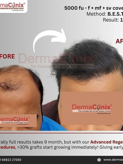With our advanced regenerative procedures combined with B.E.S.T. FUE, we can achieve earlier results. This one year outcome with 5000 follicular units shows excellent coverage and density, with over 30% of grafts growing immediately post surgery.