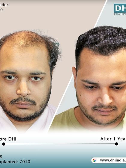 A frontal before and after of the same client one year post-transplant. The restored hairline and full, healthy hair have completely transformed his appearance and boosted his confidence.