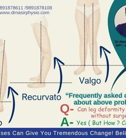 Are you worried about knock knees or bow legs showing up in your medical exam? I want you to know that you don't have to go for surgery. With the right physiotherapy exercises and manual therapy, we can correct these leg deformities and improve your alignment for defence, police, or paramilitary selection.