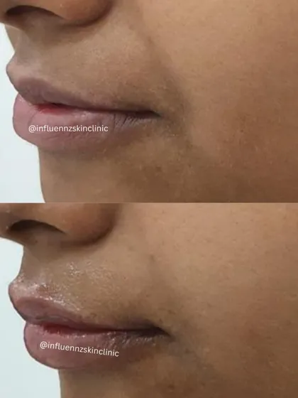 A side profile view of a lip filler result, demonstrating how we enhance projection and shape for a natural-looking pout.