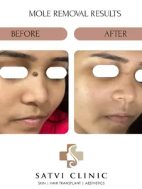 Mole & Wart Removal
