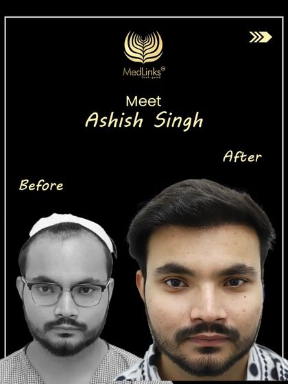 A before and after comparison for our patient Ashish Singh, showing a complete transformation from significant baldness to a full, youthful hairline.