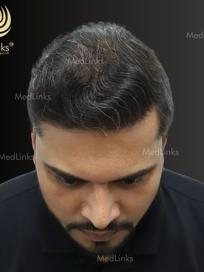 The top-down view after the transplant, showcasing the full coverage achieved.