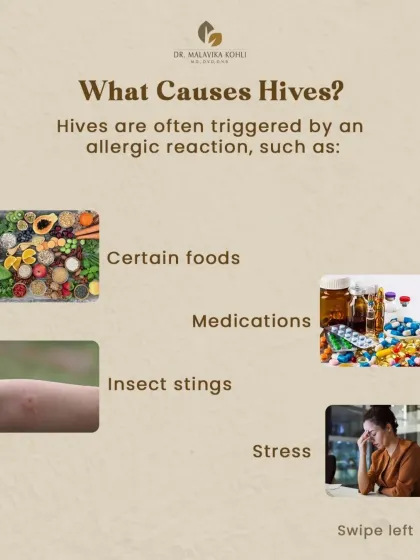 Hives are most often triggered by an allergic reaction. Common culprits include certain foods, medications, and insect stings. In some cases, stress can also be a significant trigger for an urticarial flare.