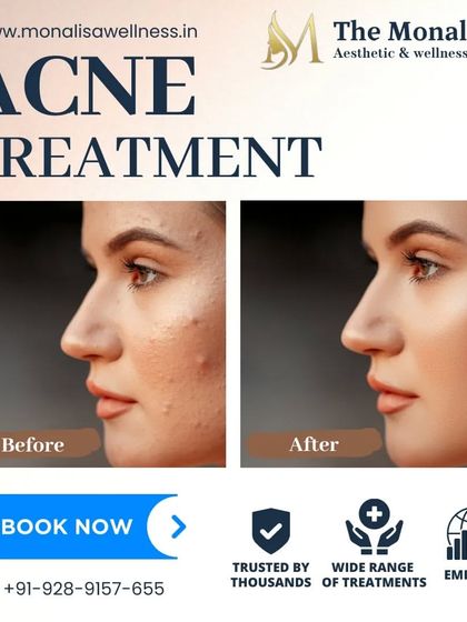 Our acne treatments deliver clear, visible improvements. This before and after profile view shows a significant reduction in inflammation and breakouts, leading to smoother, healthier-looking skin.