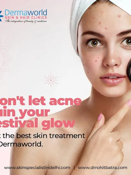 Don't let acne ruin your festive glow. Breakouts often appear at the most inconvenient times, but with the right treatment from my clinic, you can face any event with clear, confident skin.
