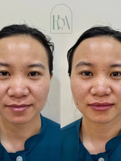 This before-and-after shows how lip fillers can restore balance to the entire face. By adding subtle volume and definition to the lips, we achieve a more harmonious and refreshed aesthetic.