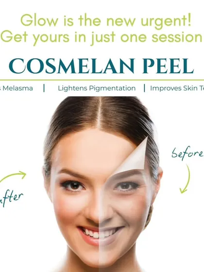 The Cosmelan Peel is an urgent solution for those who want to tackle melasma, lighten pigmentation, and improve overall skin texture. This graphic illustrates the transformative effect, showing how it peels away the old, damaged layer to reveal fresh, clear skin underneath.