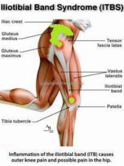 Iliotibial (IT) Band Syndrome is a common cause of outer knee pain, especially in runners. Our treatment focuses on releasing the tight band and strengthening the hip muscles to correct the underlying mechanics.